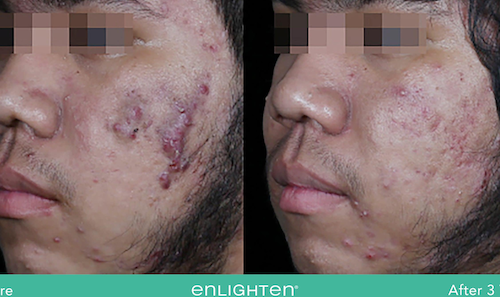 facial scarring before after results mississauga oakville toronto